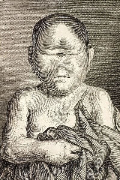 1777 Buffon Cyclopia congenital disorder