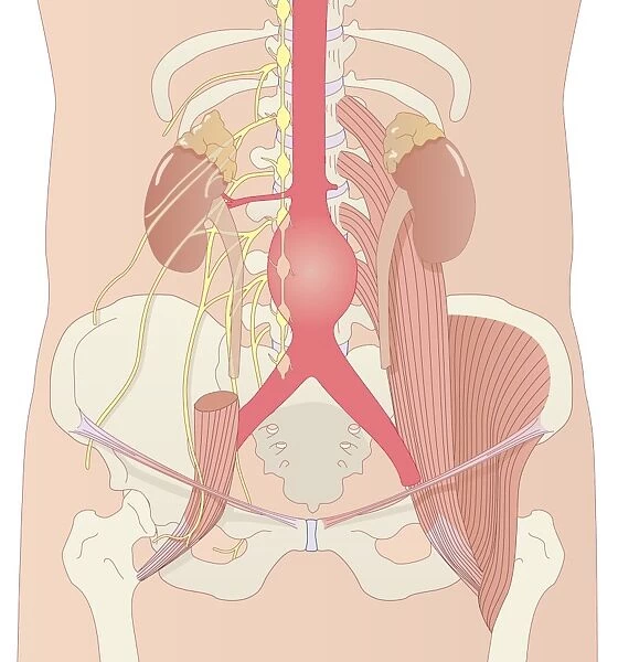 Abdominal aortic aneurysm, artwork