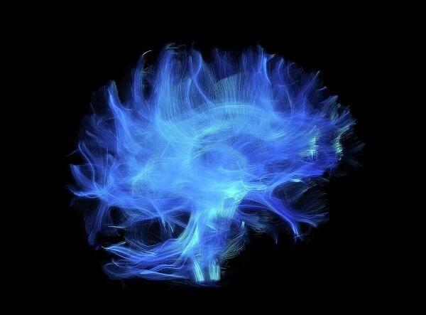 Brain fibres, DTI MRI scan C017  /  7035