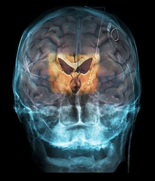 Brain implants for Parkinsons disease