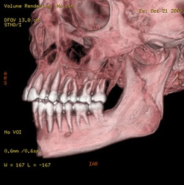 Broken chin, 3D CT scan