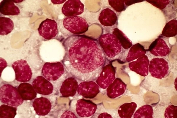 Chronic lymphocytic leukaemia, micrograph