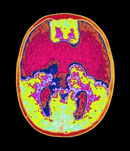 Coloured MRI brain scan showing holoprosencephaly