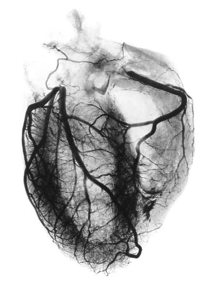 Coronary arteriogram of arteries of the heart 1904