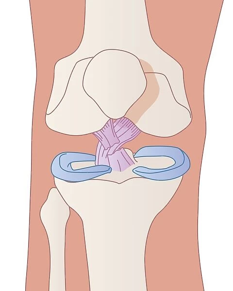 Damaged knee ligament, artwork