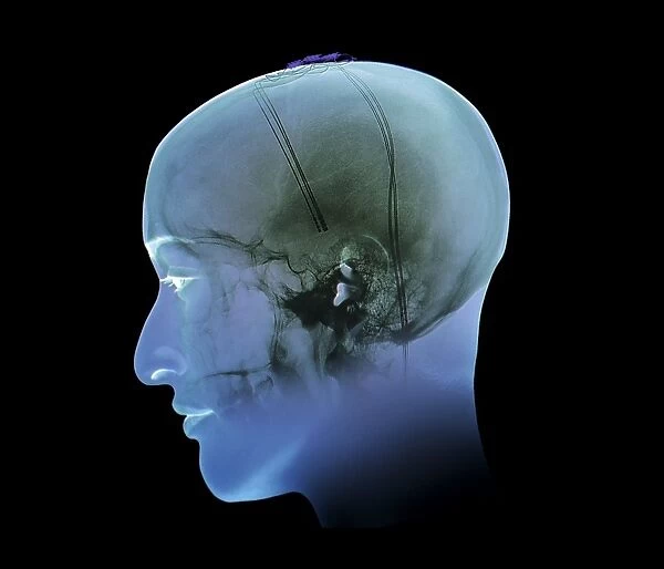 Deep brain stimulation, X-ray