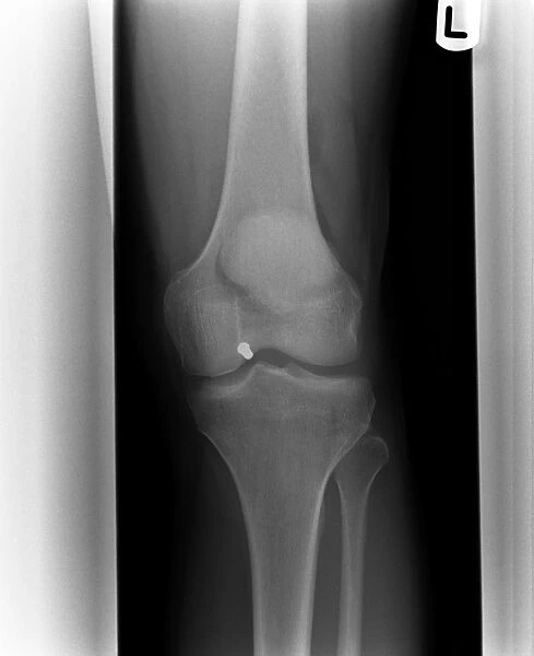 Firearm injury, X-ray