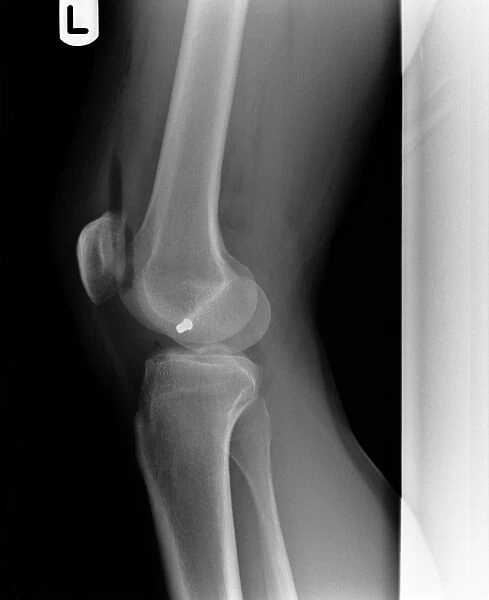 Firearm injury, X-ray