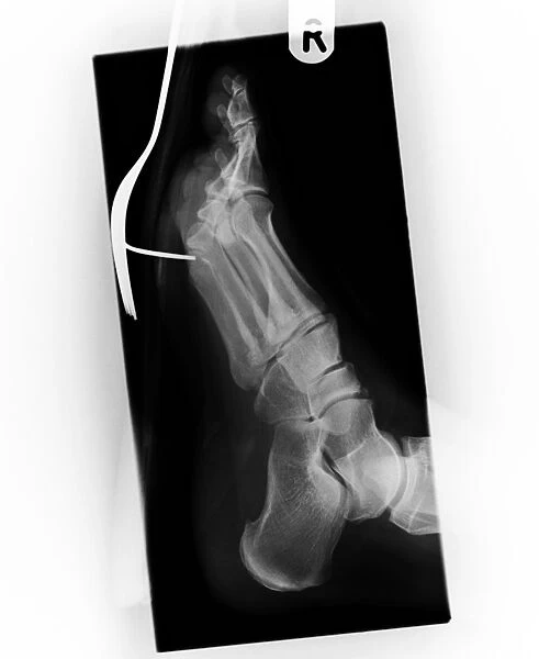 Fork impaled on a persons foot, X-ray