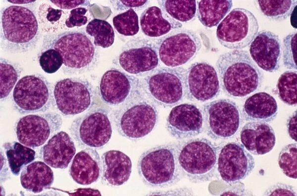 Hairy cell leukaemia, light micrograph