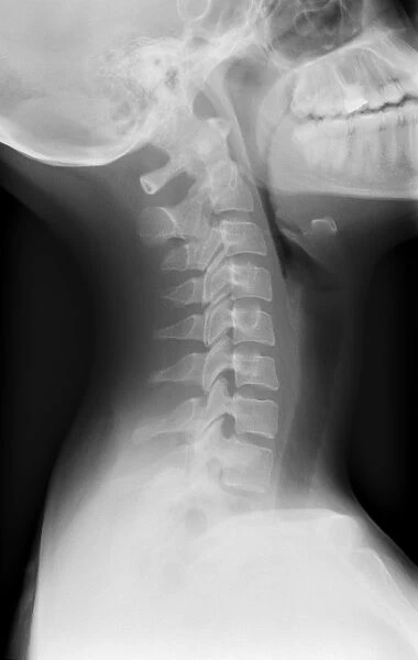 Healthy spine of the neck, X-ray
