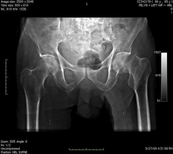 Hip fracture, digital X-ray