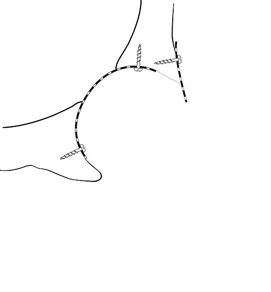 Hip socket bone grafting, diagram C016  /  6783