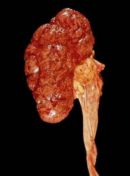 Inflamed kidney