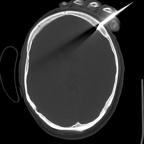 Knife in persons head, X-ray