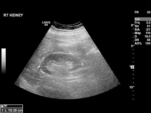 Liver mass, ultrasound scan C017  /  7780