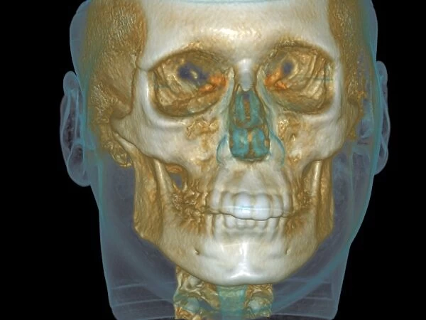 Normal head, cone beam CT scan