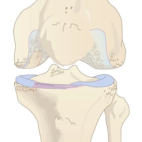Osteoarthritis of the knee, artwork