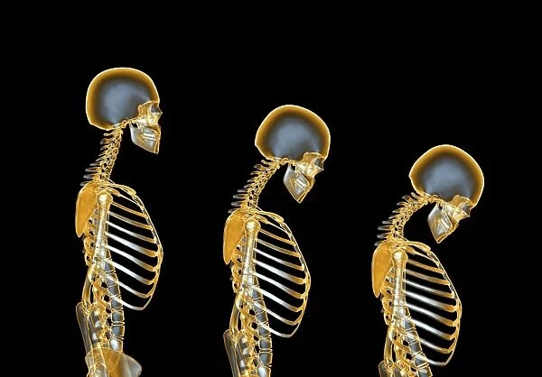 Osteoporosis. Computer artwork of a human female skeleton degenerating due to osteoporosis