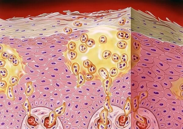Psoriasis. Artwork of a section through the skin in a case of pustular psoriasis