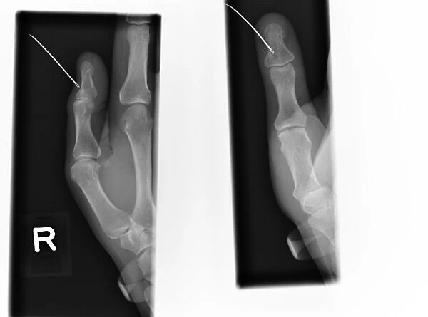 Sewing needle in thumb, X-ray