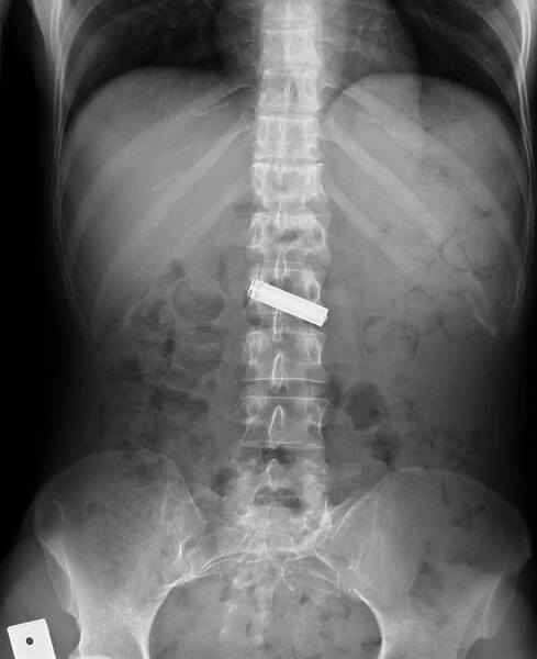 Swallowed battery, X-ray