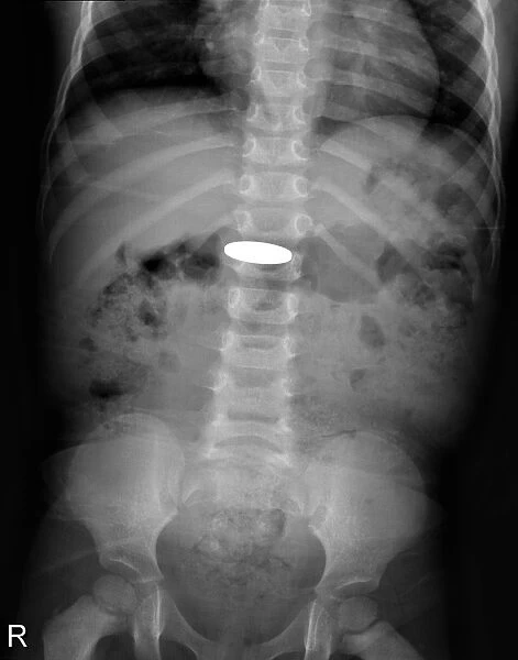 Swallowed coin, X-ray