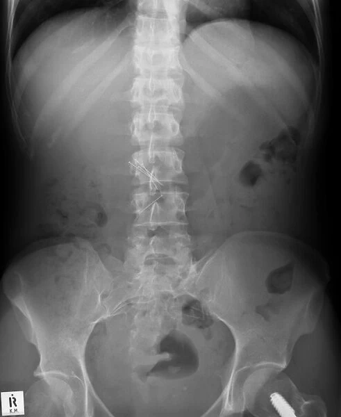 Swallowed needles, X-ray