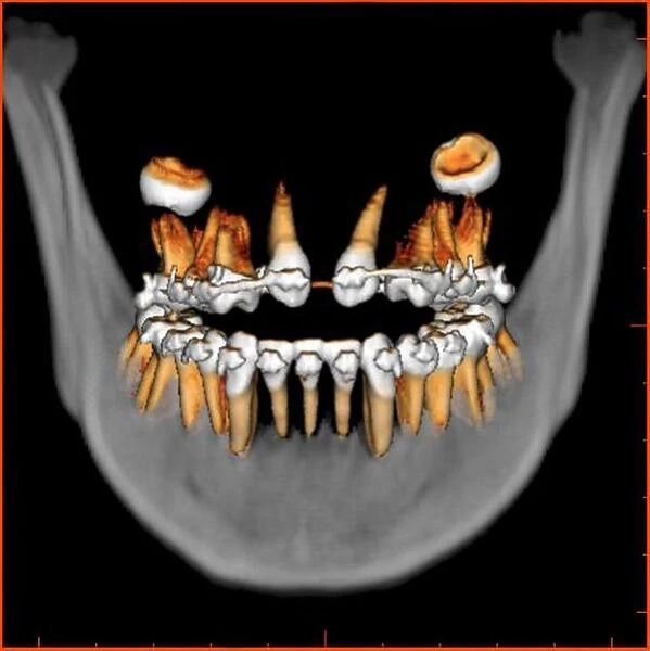 Teeth, 3D CT scan