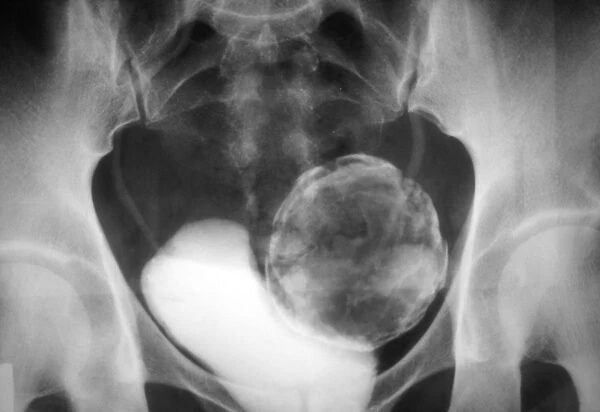 Uterine fibroid, X-ray