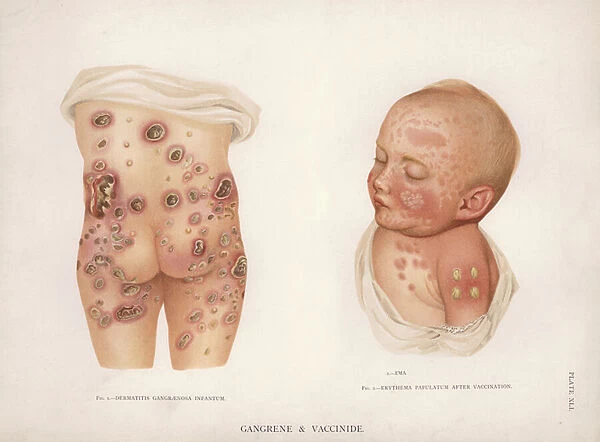 Diseases of the Skin: Gangrene and Vaccinide (colour litho)