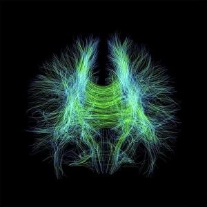Brain fibres, DTI MRI scan C017 / 7099