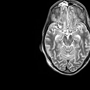 Brain injury, MRI scan
