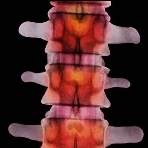 Coloured X-ray of lumbar vertebrae of the spine