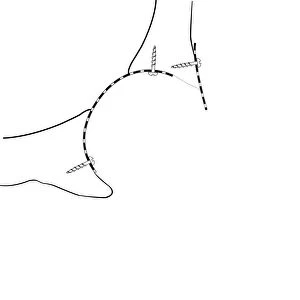 Hip socket bone grafting, diagram C016 / 6783