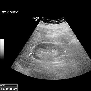 Liver mass, ultrasound scan C017 / 7780