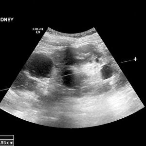 Polycystic kidney, ultrasound scan C017 / 7746