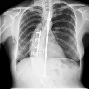 Scoliosis treatment, X-ray C017 / 7156