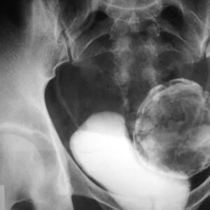 Uterine fibroid, X-ray