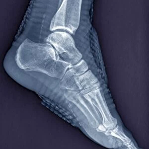 Healthy ankle joint, X-ray