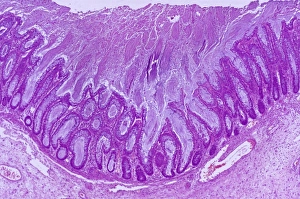 Production Prints: Colitis, light micrograph