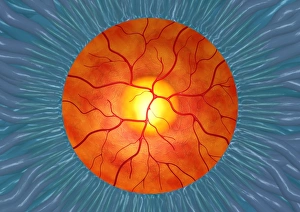 Ophthalmic Prints: Glaucoma, computer artwork
