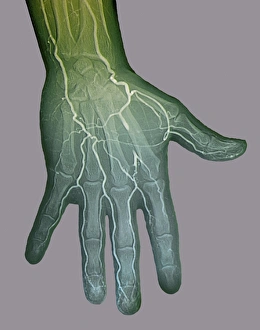 Ischaemia, digital angiogram Ischaemia, digital angiogram