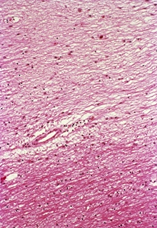 Multiple sclerosis, light micrograph
