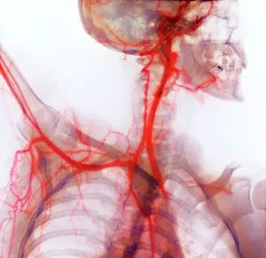Neck and shoulder arteries, X-ray Neck and shoulder arteries, X-ray