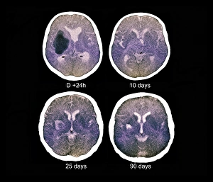 Cerebral Prints: Stroke, CT scans